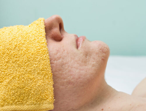 Chemical Peels: Can Chemical Peels Make Acne Scars Worse?