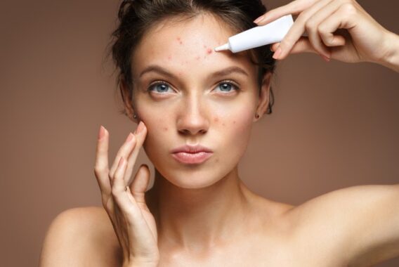 How to Know What Causes Your Acne Year-Round