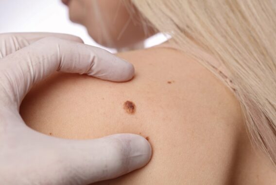 Too Much Sun? Here’s Why You Should Get a Mole Check
