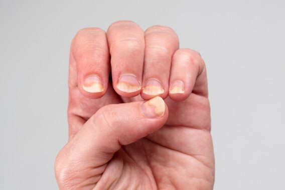 What Is a Nail Infection and How Do I Cure It?
