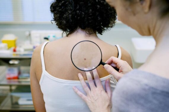 When to Get Checked for Skin Cancer
