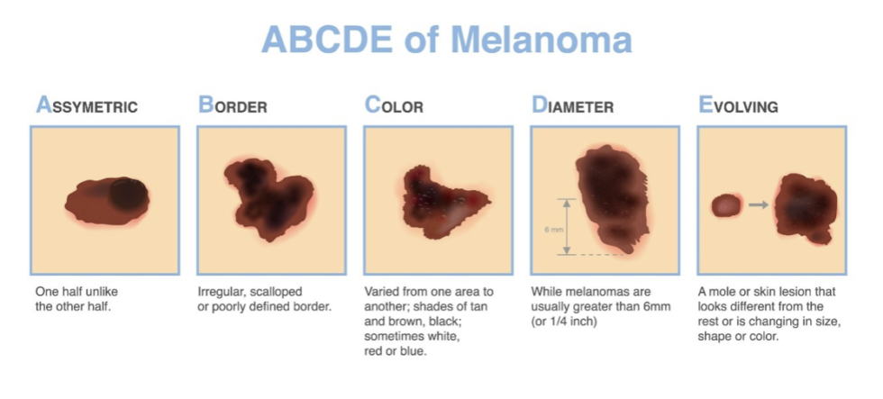Skin Cancer Awareness: What You Need to Know About Melanoma
